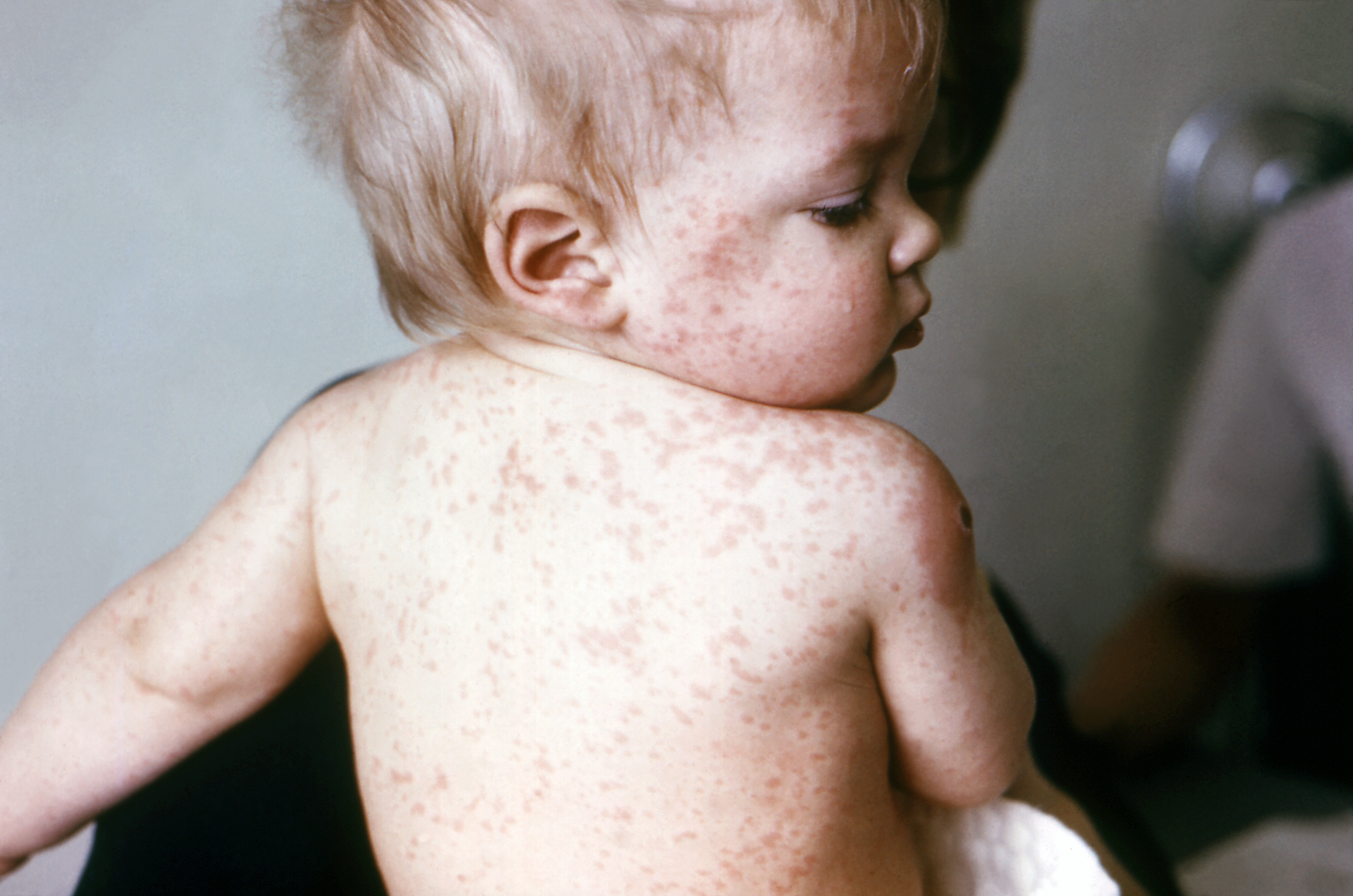 Measles Have Infected Up to 121 People in 17 States So Far As of February 6th 2015