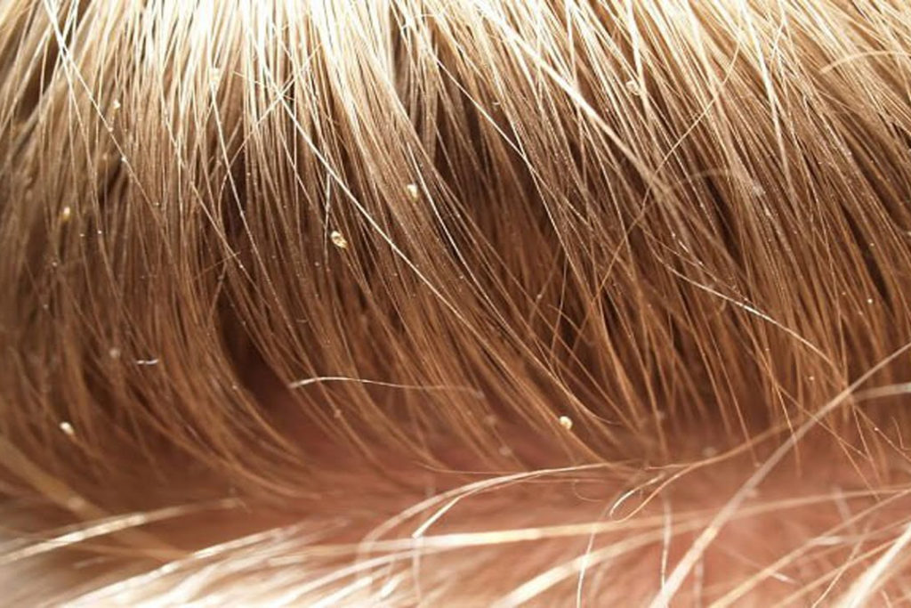 How to Detect Head Lice, Treat It, and Then Clean Your Home Afterwards ...