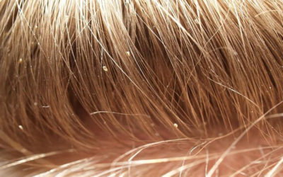 How to Detect Head Lice, Treat It, and Then Clean Your Home Afterwards…