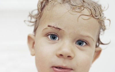 Parenting Tips – Does My Child Need Stitches?