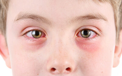 Conjunctivitis: What Is Pink Eye?…